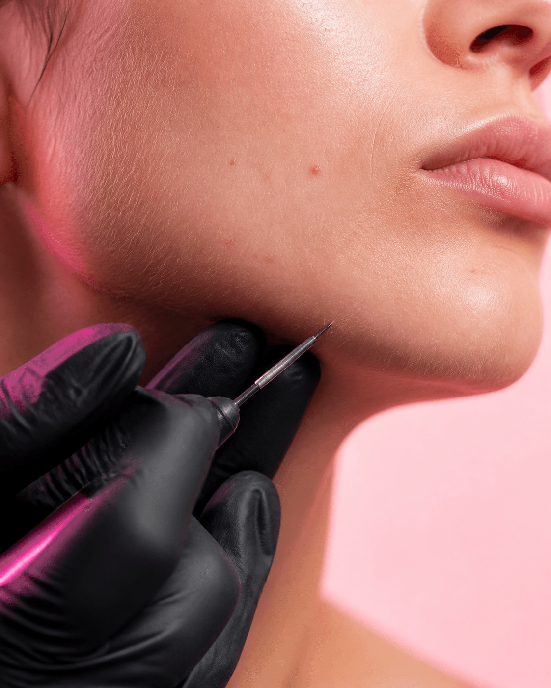 Geste précis d’électrolyse sur le visage