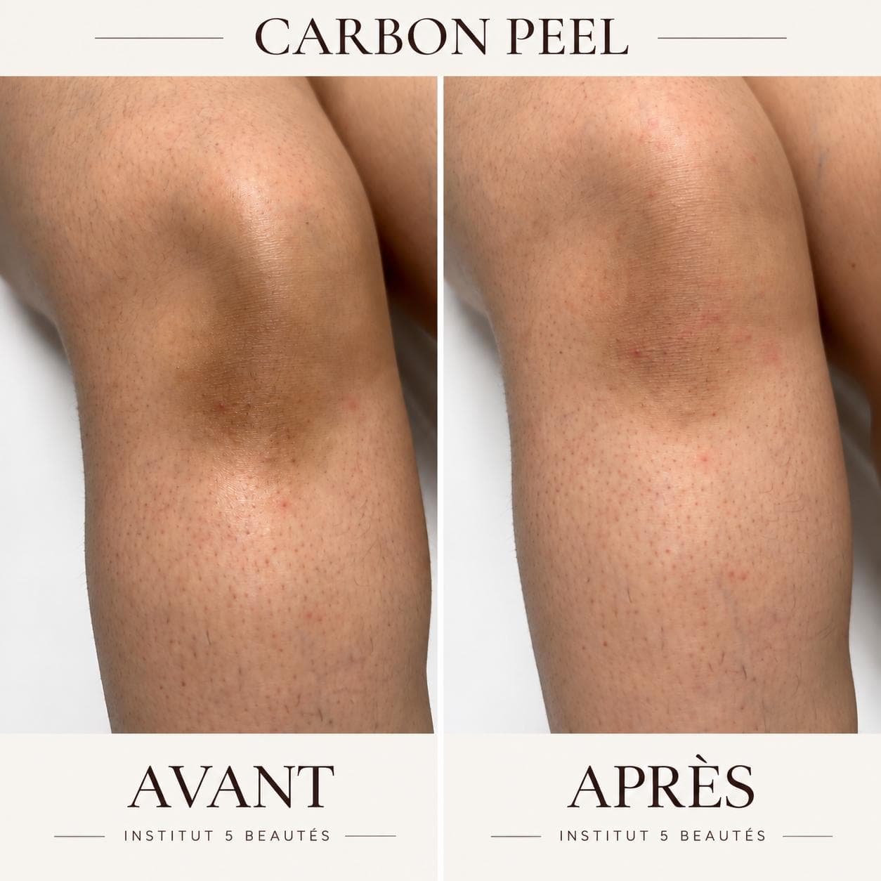Carbon Peel · genou — réalisation présentée par Cinq Beautés