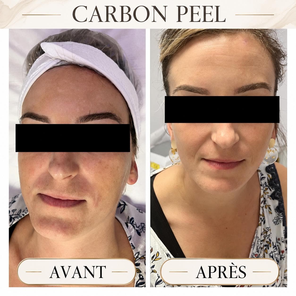 Carbon Peel · visage — réalisation présentée par Cinq Beautés