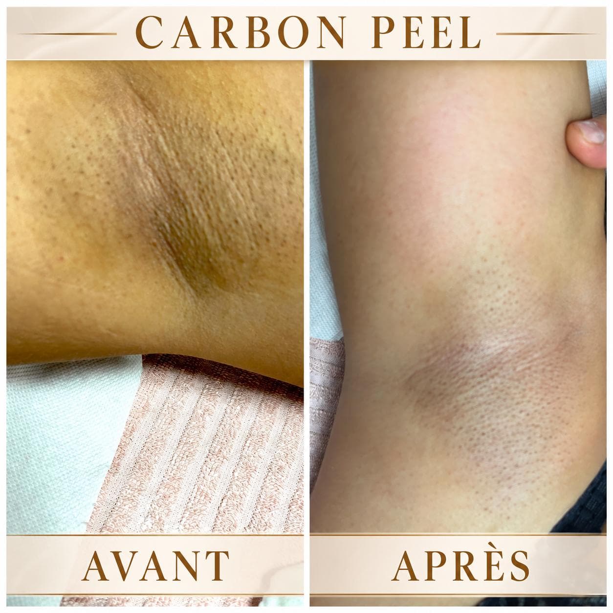Carbon Peel · soin ciblé — réalisation présentée par Cinq Beautés