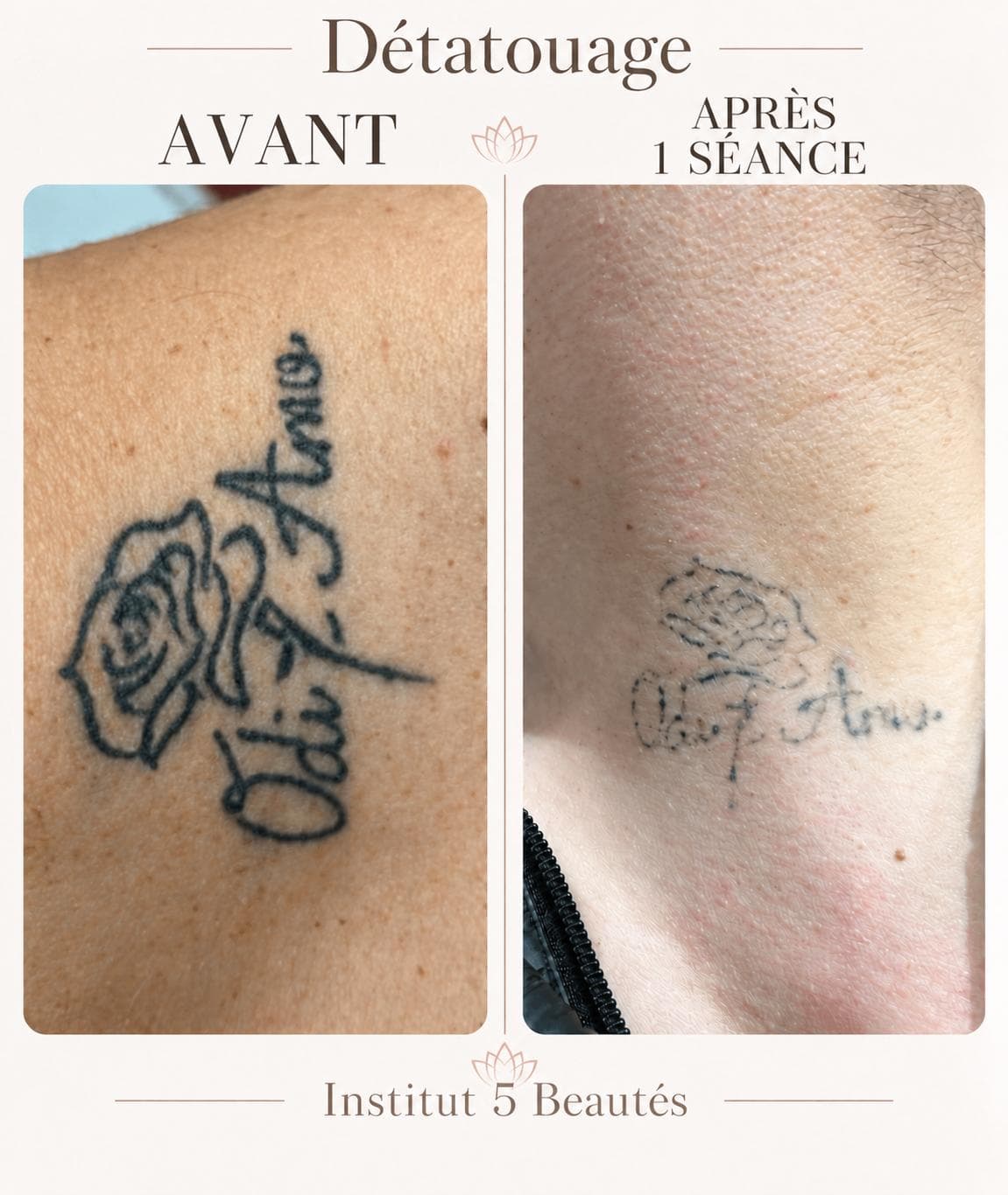 Détatouage · suivi en images — réalisation présentée par Cinq Beautés