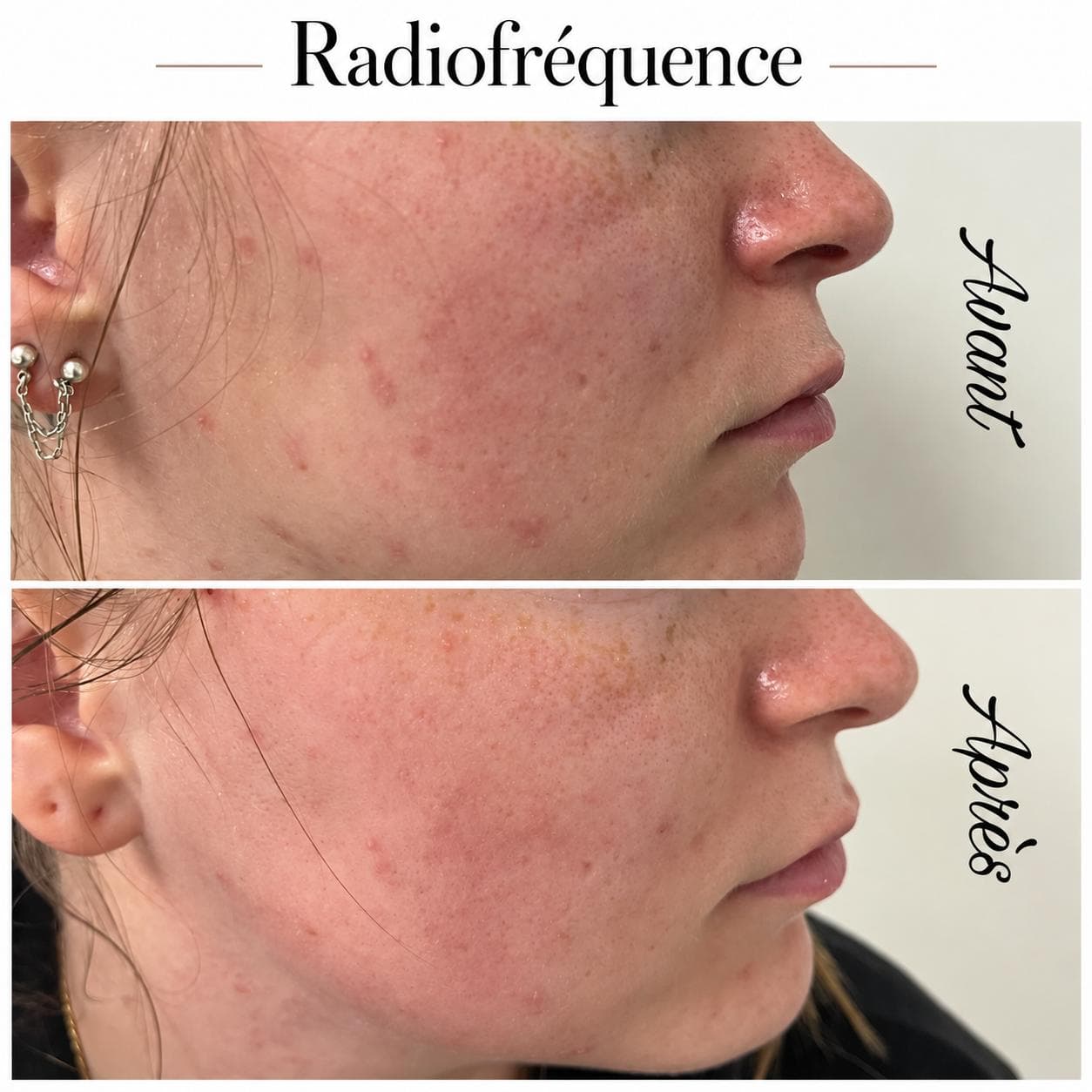 Radiofréquence · visage — réalisation présentée par Cinq Beautés