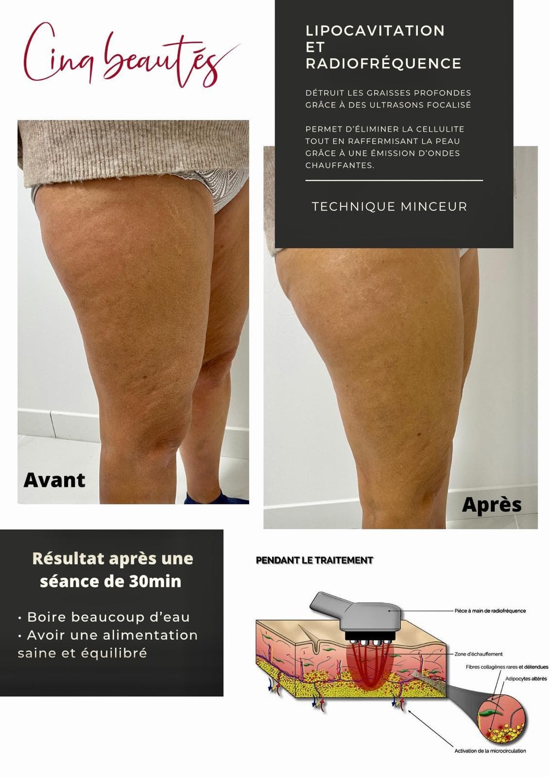 Lipocavitation & radiofréquence · cuisses — réalisation présentée par Cinq Beautés