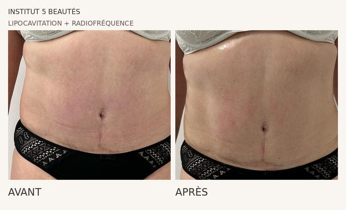 Lipocavitation & radiofréquence · ventre — réalisation présentée par Cinq Beautés